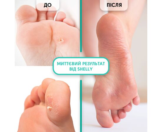 SHELLY. Keratolytic gel for local application, Soft blade, 100 ml. Гель-кератолітик для локального застосування "М'яке лезо" #4
